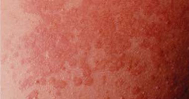 دكتور محمد حسين أبو حديد يكتب: التنيا الملونة خطر كبير على جلدك
