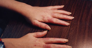 إحمرار الأصابع ليست دائما مرضا جلديا.. تعرف على الأمراض المناعية المسببة له 