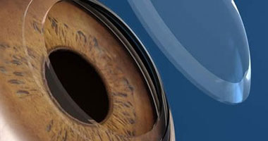 العين الصناعية متى تكون حلا لتشوهات العين