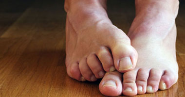 أخصائى أمراض جلدية تقدم وصفات بسيطة لعلاج مسامير القدم بالمنزل