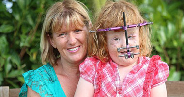 بالصور.. تعافى طفلة بريطانية تعانى من متلازمة "الدمية المكسورة"