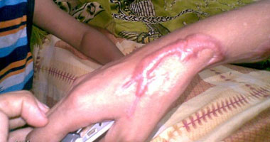 "الشرقية": نقل حالتى حروق بحالة خطرة من الإسماعيلية إلى مستشفى بلبيس
