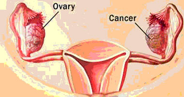 أدوية علاج سرطان الثدى تؤدى إلى الإصابة بسرطان بطانة الرحم