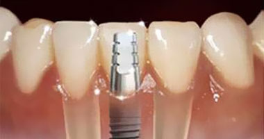 ما الحل لمشكلة فقد الأسنان أو تلفها؟