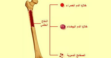 ما هو مرض "فقر الدم اللا تنسجى"؟