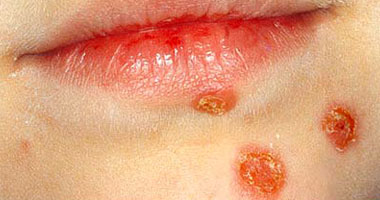 علاج مرض الحصف الجلدى بالمضادات الحيوية وقص أظافر الأطفال