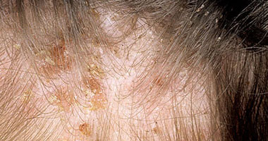 الإصابة الميكروبية بفروة الرأس أحد أهم أسباب تساقط الشعر اليوم السابع