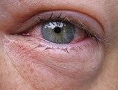 أخصائية باطنة توضح أسباب تضخم العينين عند الاستيقاظ وكيفية علاجها