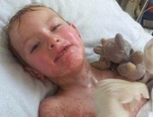 فوكس نيوز: "دواء صرع" يتسبب فى تساقط جلد طفل بريطانى