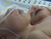 نقل الطفل المولود برأسين وقلبين إلى مستشفى جراحات اليوم الواحد ببنها