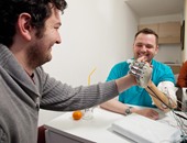 سويدية مبتورة اليد تبتكر يد روبوت قادرة على الإحساس والتمييز