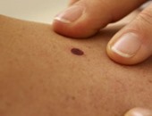 دراسة بريطانية خطيرة: وجود 10 "حسنات" بذراعك يعرضك للإصابة بسرطان الجلد