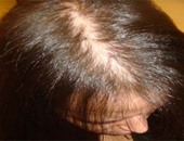 تعرف على أهم 5 أسباب لحدوث الصلع وتساقط الشعر