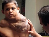 جراحون ينجحون فى إزالة ورم ضخم ونادر من رقبة طفل مكسيكى