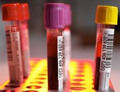 تحليل دم جديد يكشف عن السرطان ويحدد مكانه فى الجسم