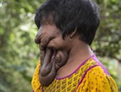 بالفيديو.. خديجة امرأة بلا وجه بسبب مرض نادر أخفى ملامحها