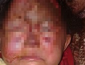 تجمهر أسرة الطفلة سما ضحية التشويه داخل صيدلية أمام نيابة أوسيم