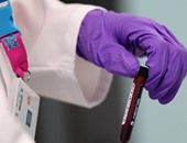 4 حالات ضرورية.. متى تحتاج لإجراء تحليل نسب الفوسفات فى الدم؟