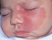 ما علاج الوحمات الدموية؟