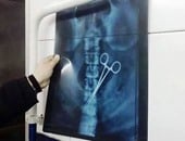 بالصور.. طبيب ينسى "مقص طبى" داخل أمعاء مريض بعد عملية استئصال ورم