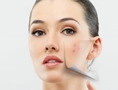 خبيرة تجميل تقدم 4 نصائح طبيعية لعلاج "بثور" الوجه