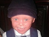 طفل بريطانى يُعانى من حالة وراثية نادرة فى الجلد تجعله يشبه السمكة