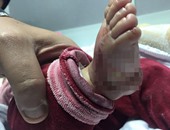 بالصور.. استئصال جزء من قدم طفلة حديثة الولادة نتيجة إهمال طبى بمدينة نصر