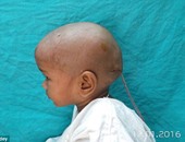 بالصور.. علاج طفلة هندية من ورم نادر بحجم كرة القدم فى الرأس