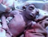 بسبب سوء تغذية الأم.. "الفتاة المعجزة" ولدت بنصف رأس وماتت بعد 48 ساعة