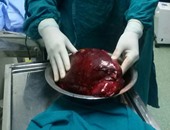 بالصور..استئصال ورم سرطانى يزن 14 كجم لمريض بمستشفى جامعة المنوفية