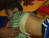 ارتفاع حالات الإصابة بالحصبة فى حميات بنى سويف إلى 22 طفلا