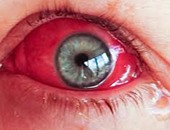 طبيب عيون: نزيف العين يحدث نتيجة ضربة قوية مباشرة عليها