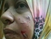 تداول صورة لتشويه بلطجية وجه طبيبة بمستشفى القاهرة الفاطمية
