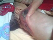 والد طفل بالإسكندرية: مستشفى السبع والشاطبى حرقوا ذراع ابنى
