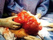 بالصور.. استئصال أكبر ورم ليفى فى العالم من رحم امرأة يزن 10 كيلو جرامات