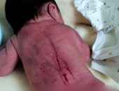 بالصور.. إهمال مستشفى خاص يُصيب طفلا حديث ولادة بجروح خطيرة فى ظهره