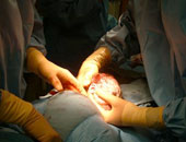 الولادة القيصرية واللبن الصناعى يعرضان الأطفال للإصابة بالربو