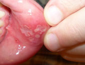 استشارى طب أسنان: التوتر يسبب الإصابة بقرح الفم