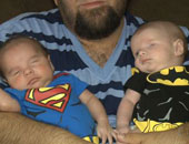 عيب خلقى نادر يتسبب فى ولادة توأم بدون عيون بأمريكا