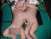 حكم فصل التوأمين الملتصقين إذا كان يترتب على ذلك موت أحدهما؟ الإفتاء تجيب 