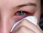 تعرف على أبسط علاج فعال لالتهابات العيون