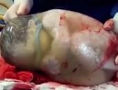 بالفيديو.. طفل إسبانى يولد من بطن أمه داخل "غشاء أمينوسى"