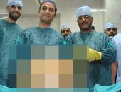استئصال ورم سرطانى يزن 38 كيلو من بطن عجوز بجامعة أسيوط