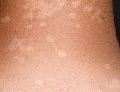 الطفح الجلدى وتضخم الغدد الليمفاوية.. أهم أعراض "الحصف الجلدى"