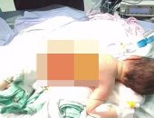 إجراء جراحة لاستئصال "قيلة عصبية" لطفلة بعد 5 أيام من ولادتها بدمياط