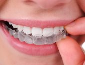 7 حقائق يجب معرفتها قبل تركيب التقويم الشفاف على أسنانك