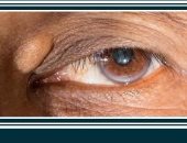 4 علاجات منزلية للتخلص من الكوليسترول السيئ حول العينين