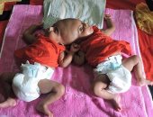 بالصور.. ولادة توأم ملتصق من الرأس فى بنجلاديش والأطباء يؤجلون الفصل