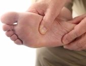 أعراض القدم السكرى أهمها تلون الجلد ووخز مؤلم