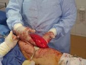 أطباء الشرقية ينجحون فى استئصال ورم وزنه 1.5 كيلو من قدم مريضة